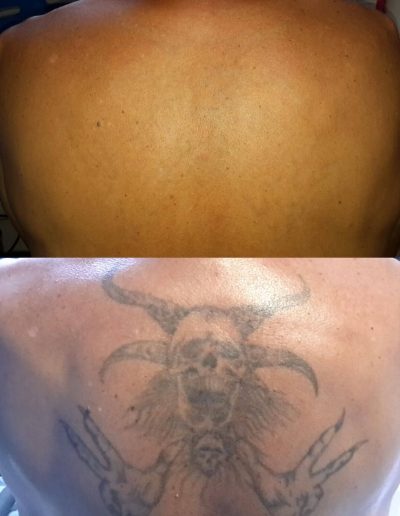 Laser tattoo removal Orlando