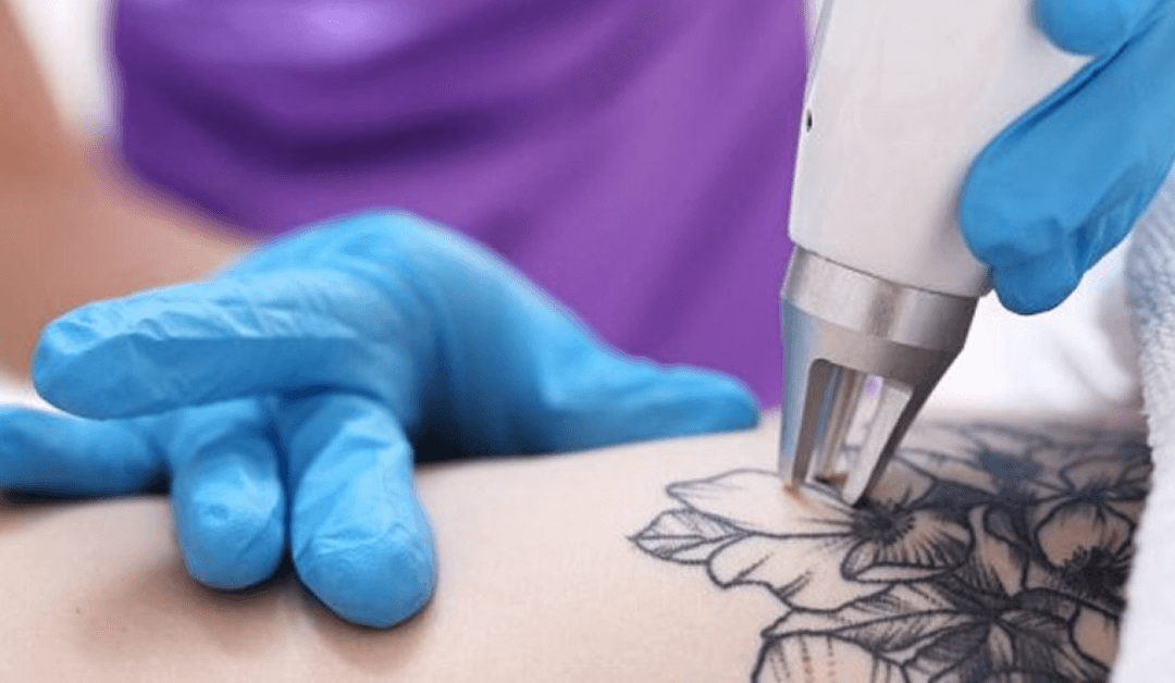 How To Know If You’re A Good Candidate for Laser Tattoo Removal