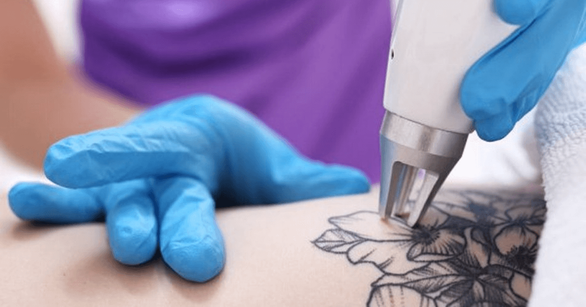 tattoo removal