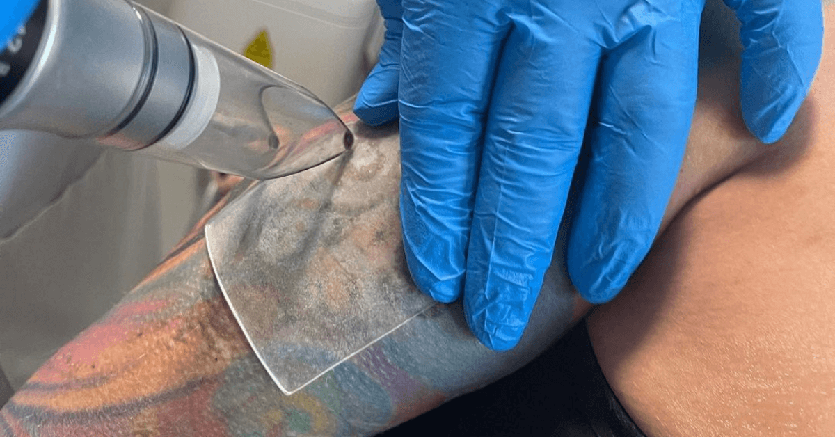 UV rays affecting tattoo removal