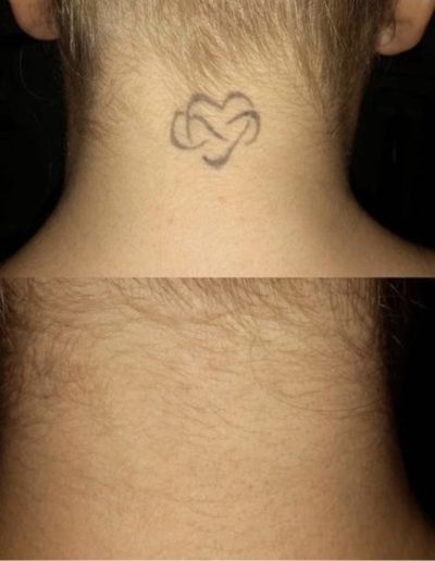Tattoo removal before and after