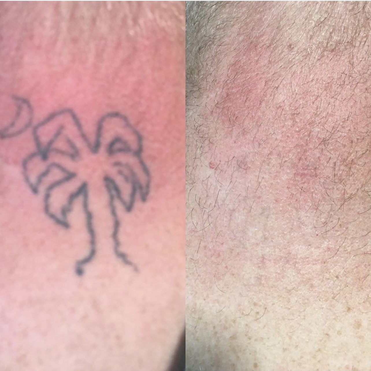 Tattoo removal before and after