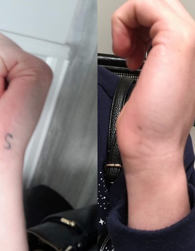 Tattoo removal before and after