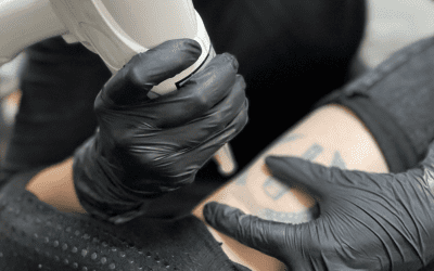 Laser Tattoo Removal FAQs: Everything You Need To Know