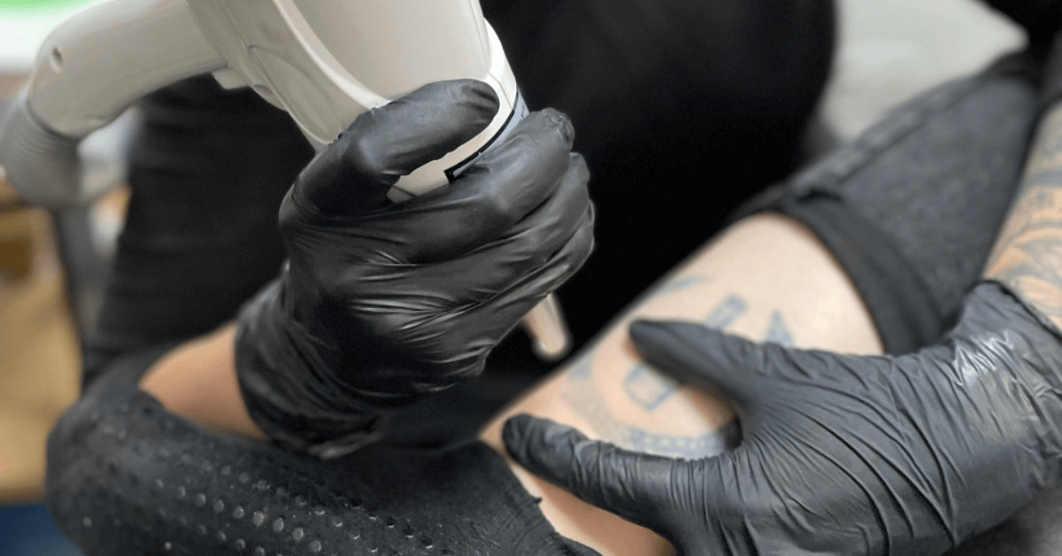 Tattoo Removal FAQs