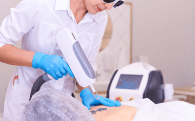 Winter Park Tattoo Removal for New Tattoos!