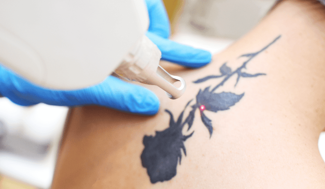 Erase & Embrace: The Art of Starting anew with Tattoo Removal