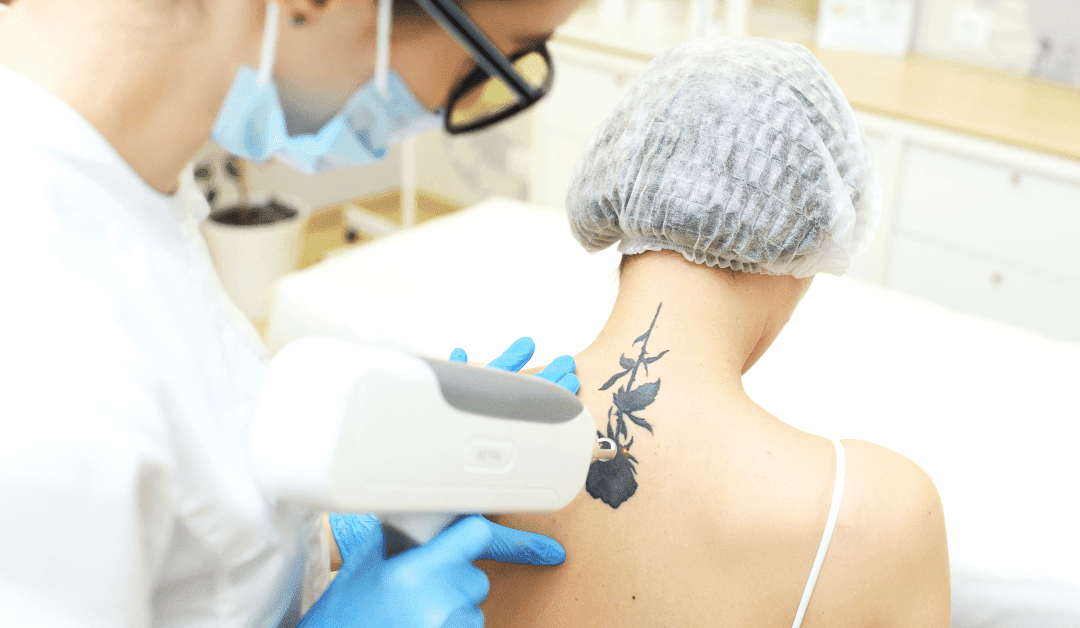Say Goodbye to Ink and Scars: The Best Tattoo Removal Treatment