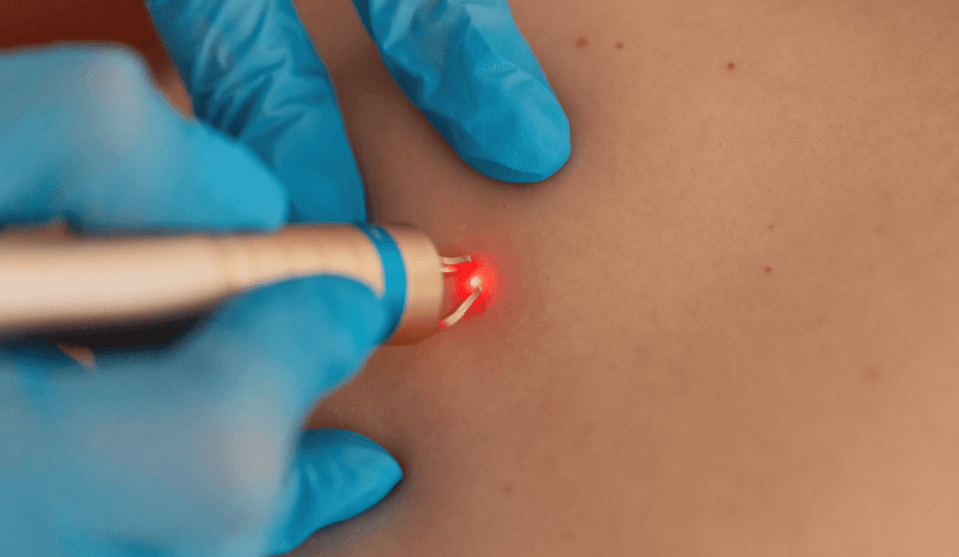 Laser Tattoo Removal: Neck, Hand, and Color Tattoos at Winter Park