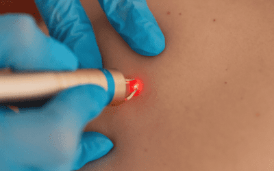 Laser Tattoo Removal: Neck, Hand, and Color Tattoos at Winter Park