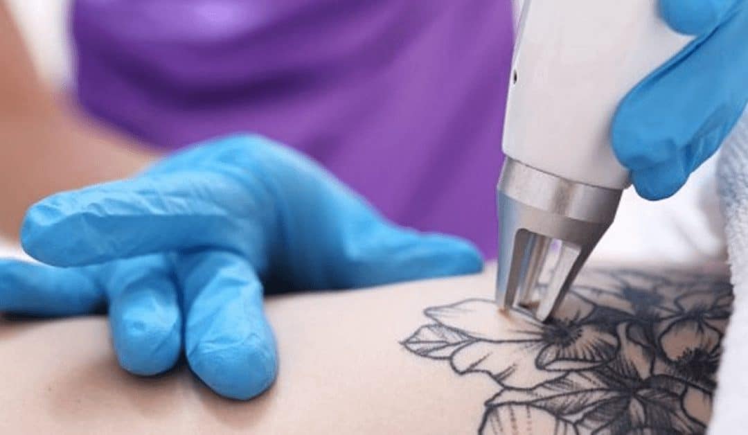 The Journey of Uninking at Winter Park Tattoo Removal Center