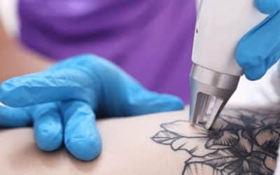 The Journey of Uninking at Winter Park Tattoo Removal Center