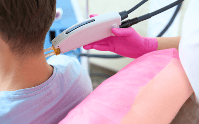 Tattoo Regret? Learn Why Some Body Parts Make Removal a Breeze