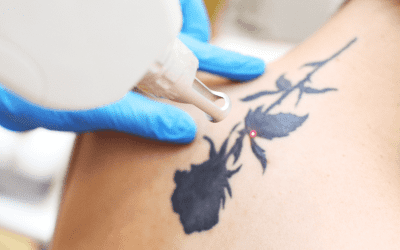 Starting Fresh: Your Journey with Laser Tattoo Removal