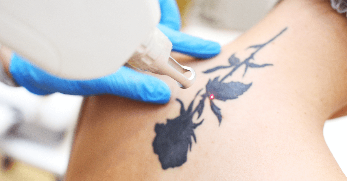 Laser Tattoo Removal