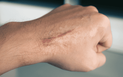 The Journey to Scar-Free Skin: Expectations of Laser Treatment