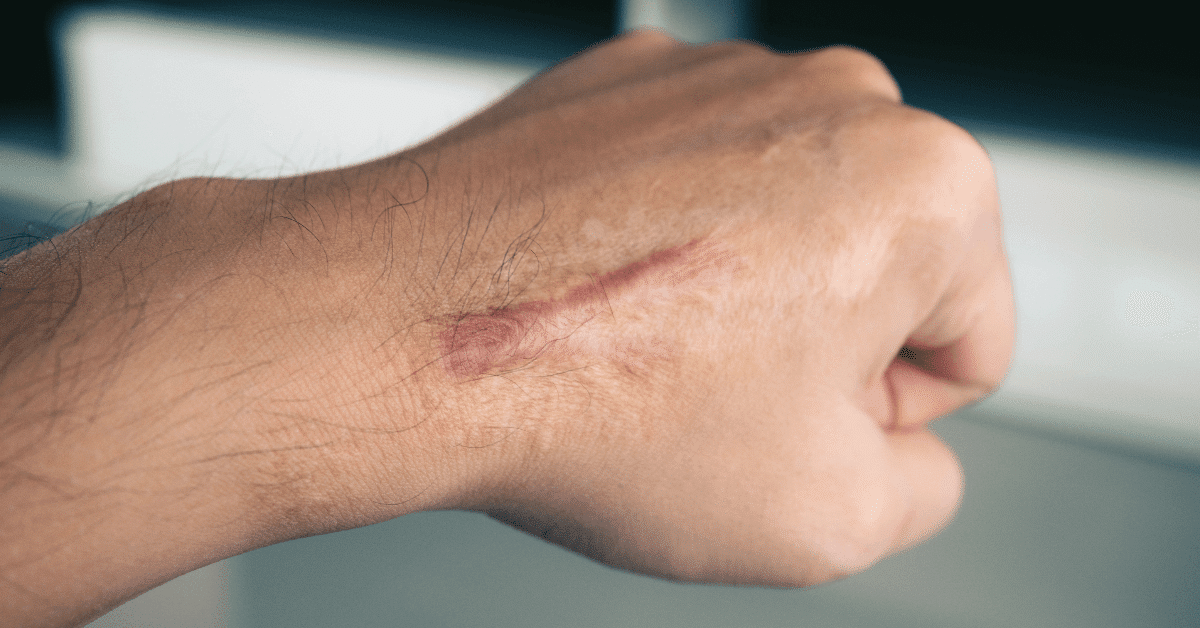 Laser Treatment for Scars