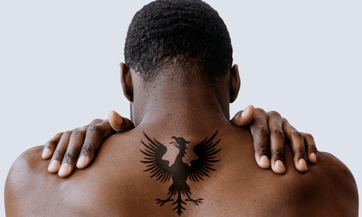 Dark Skin Tattoo Removal