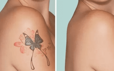 Before and After: Real Results at Winterpark Tattoo Removal