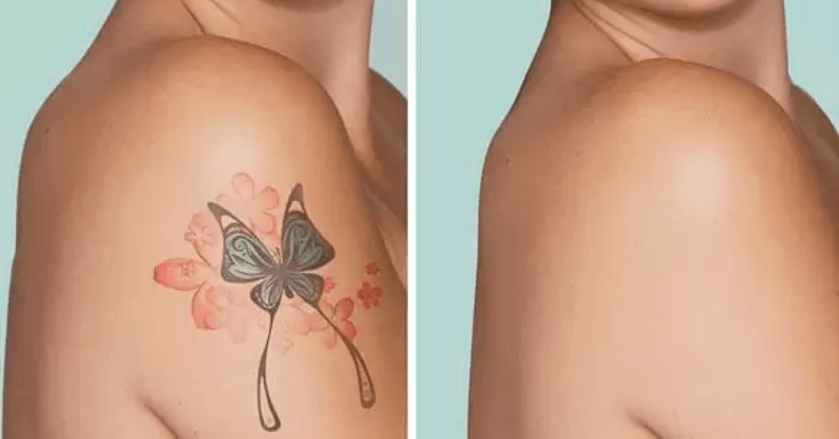 Tattoo Removal Before and After