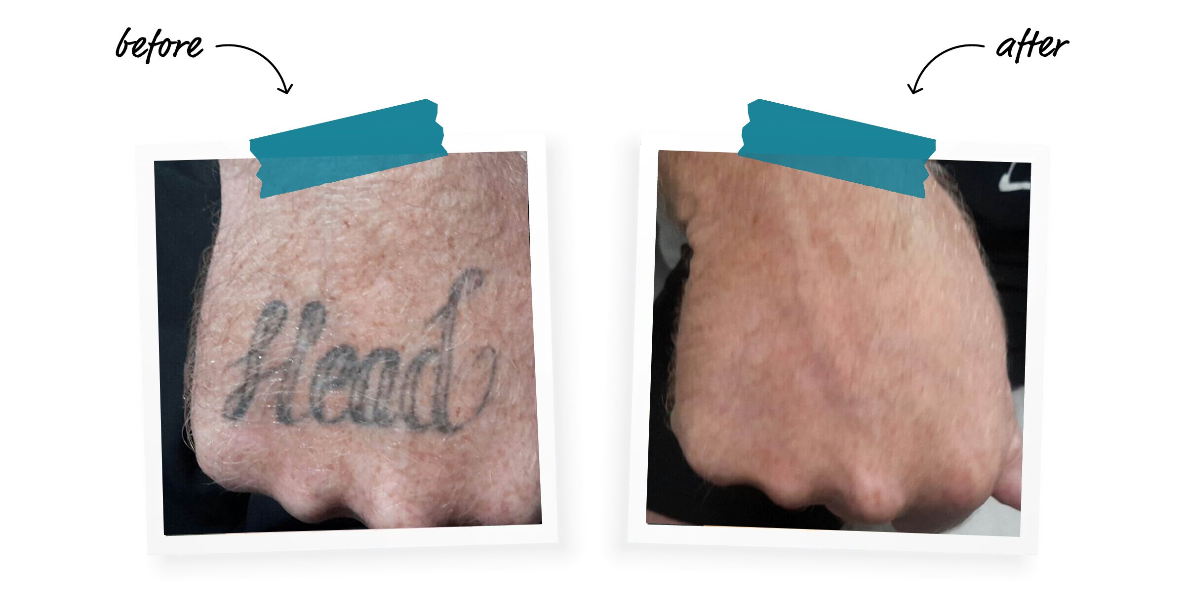 Winter Park tattoo removal clinic