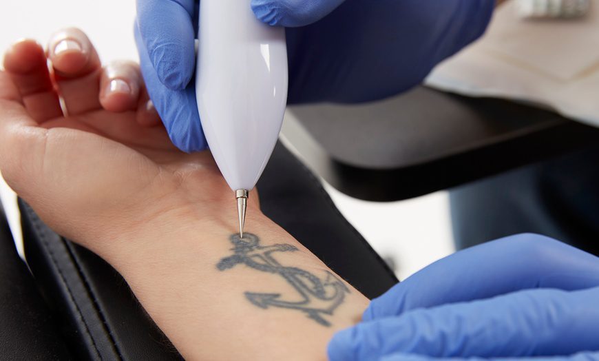 How Technology Has Advanced to Provide the Best Tattoo Removal Treatment?