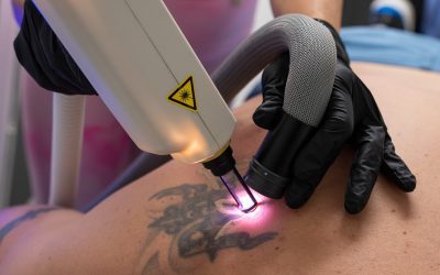 Tattoo Removal Near Me—Say Goodbye to Unwanted Ink