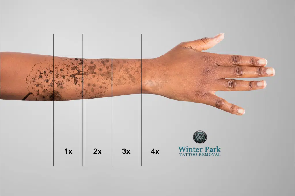 Laser Tattoo Removal