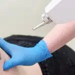 Advanced laser tattoo removal