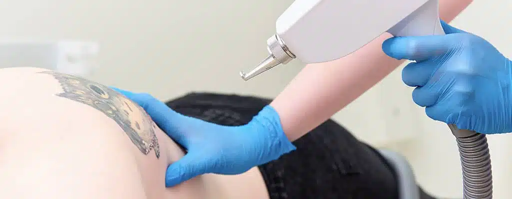 Advanced Laser Tattoo Removal in Winter Park, FL