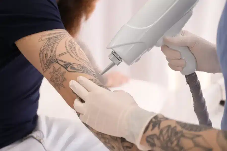 Best Laser For Tattoo Removal
