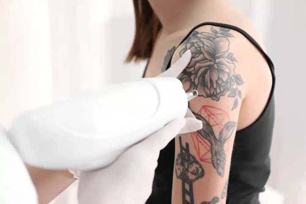 Best Laser For Tattoo Removal