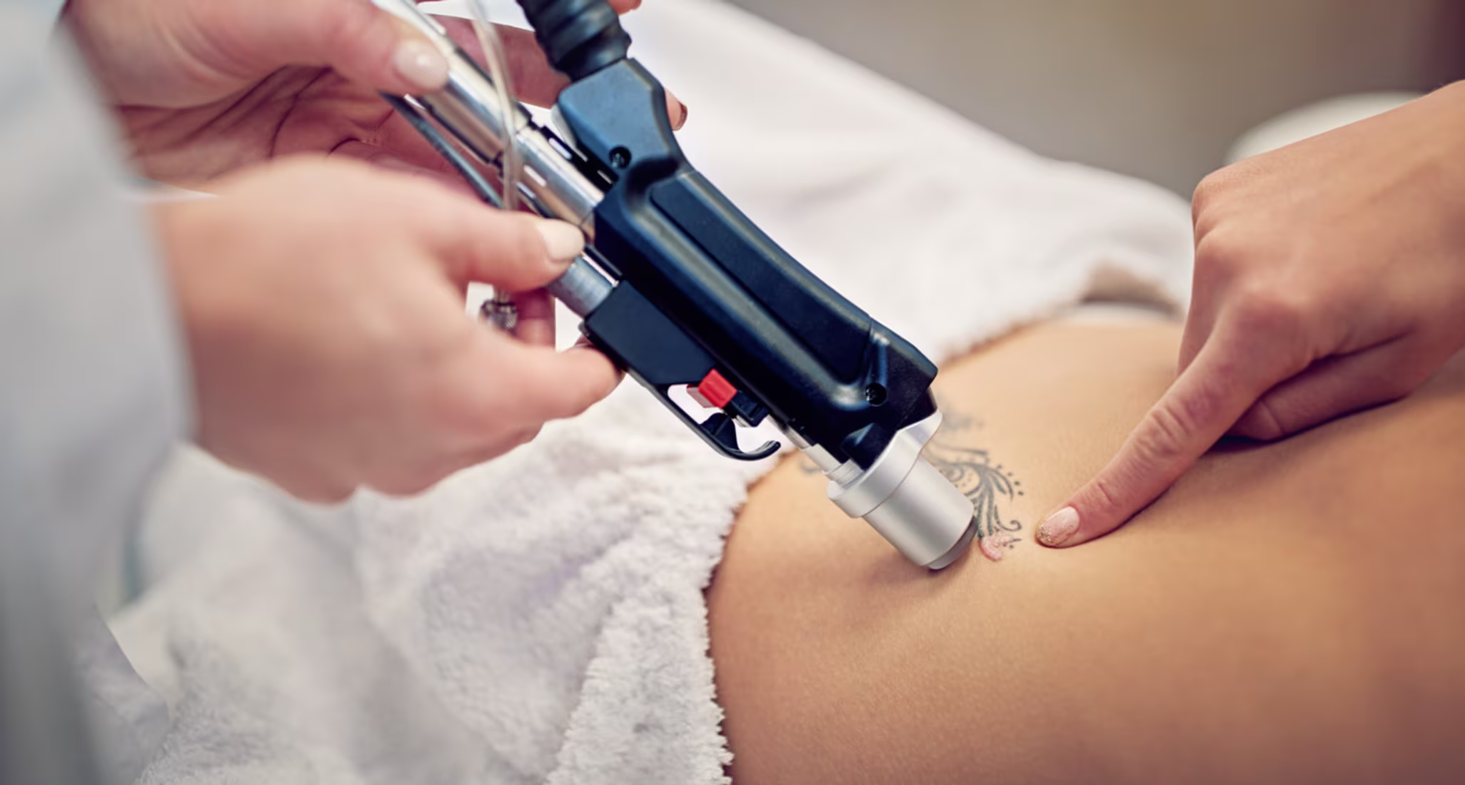 Best Laser For Tattoo Removal