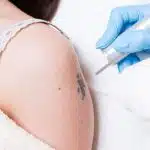 cosmetic tattoo removal