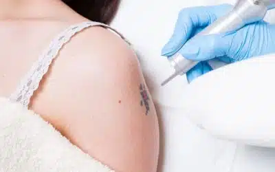 Cosmetic Tattoo Removal