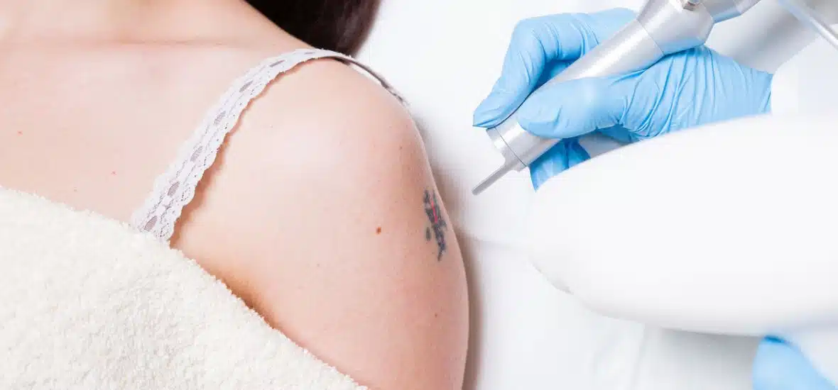 cosmetic tattoo removal