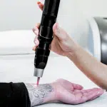 Top Tattoo Removal Laser Machines