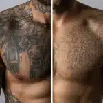Tattoo Removal Black People