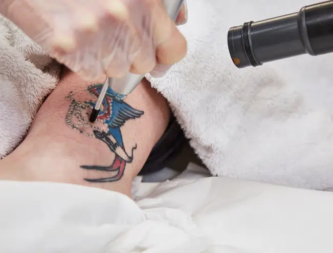 Top Tattoo Removal Laser Machines