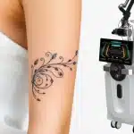 New Laser Tattoo Removal Technology