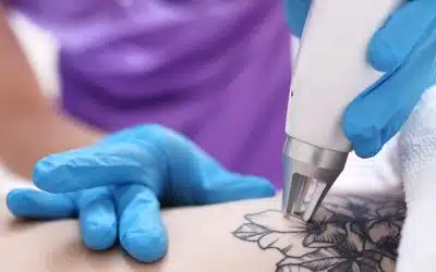 Latest Tattoo Removal Technology
