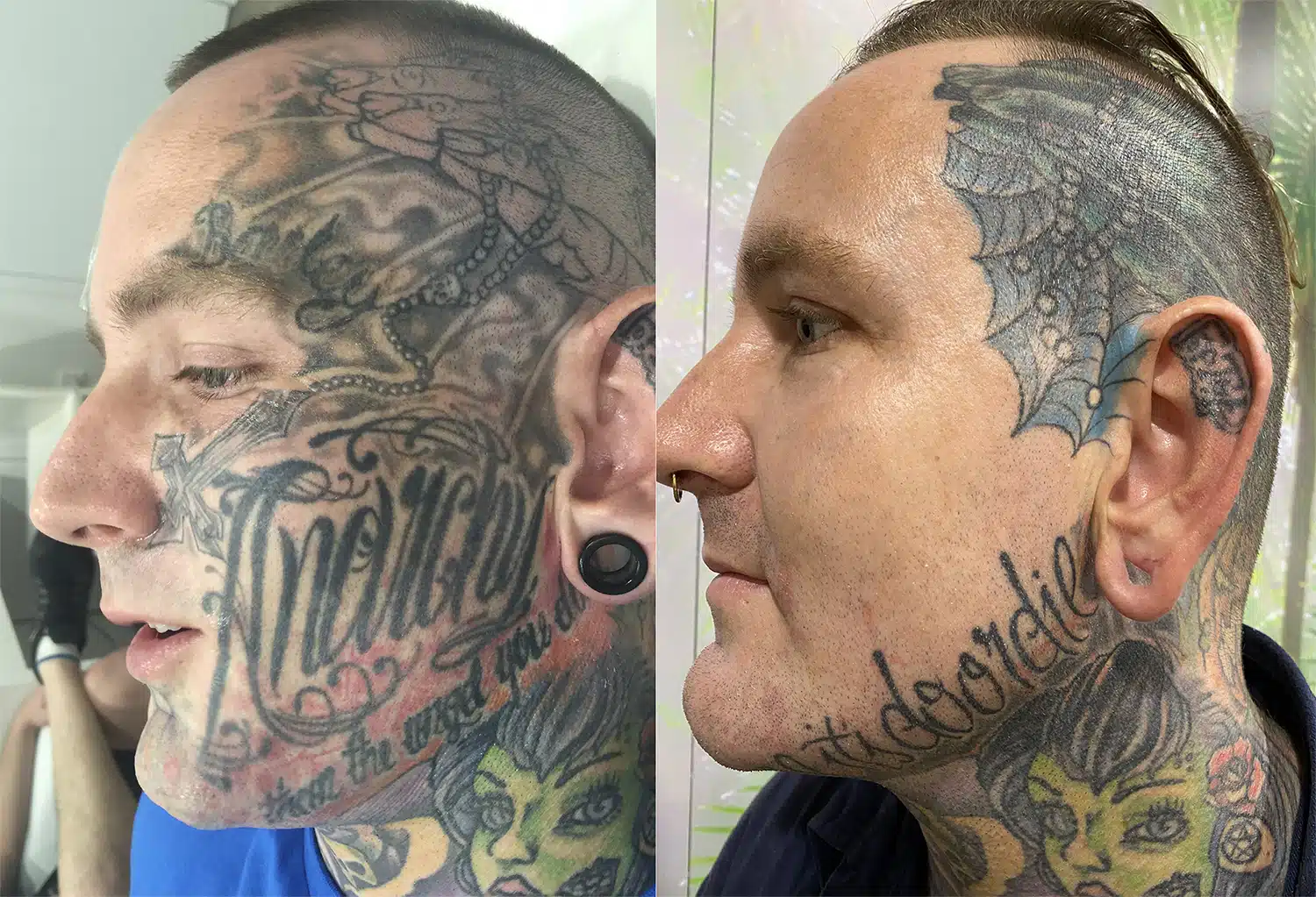 Tattoo Removal Before and After Orlando