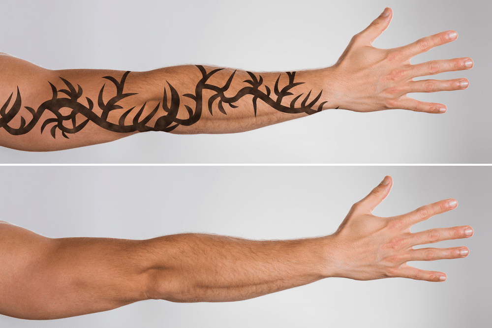 Dark Black Tattoo Removal