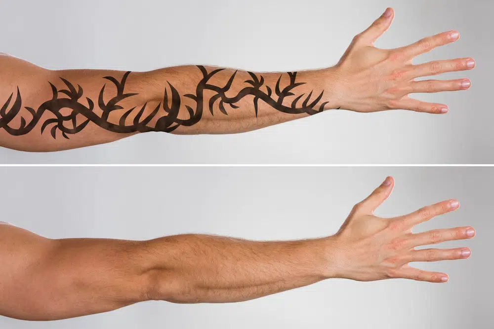 Dark Black Tattoo Removal