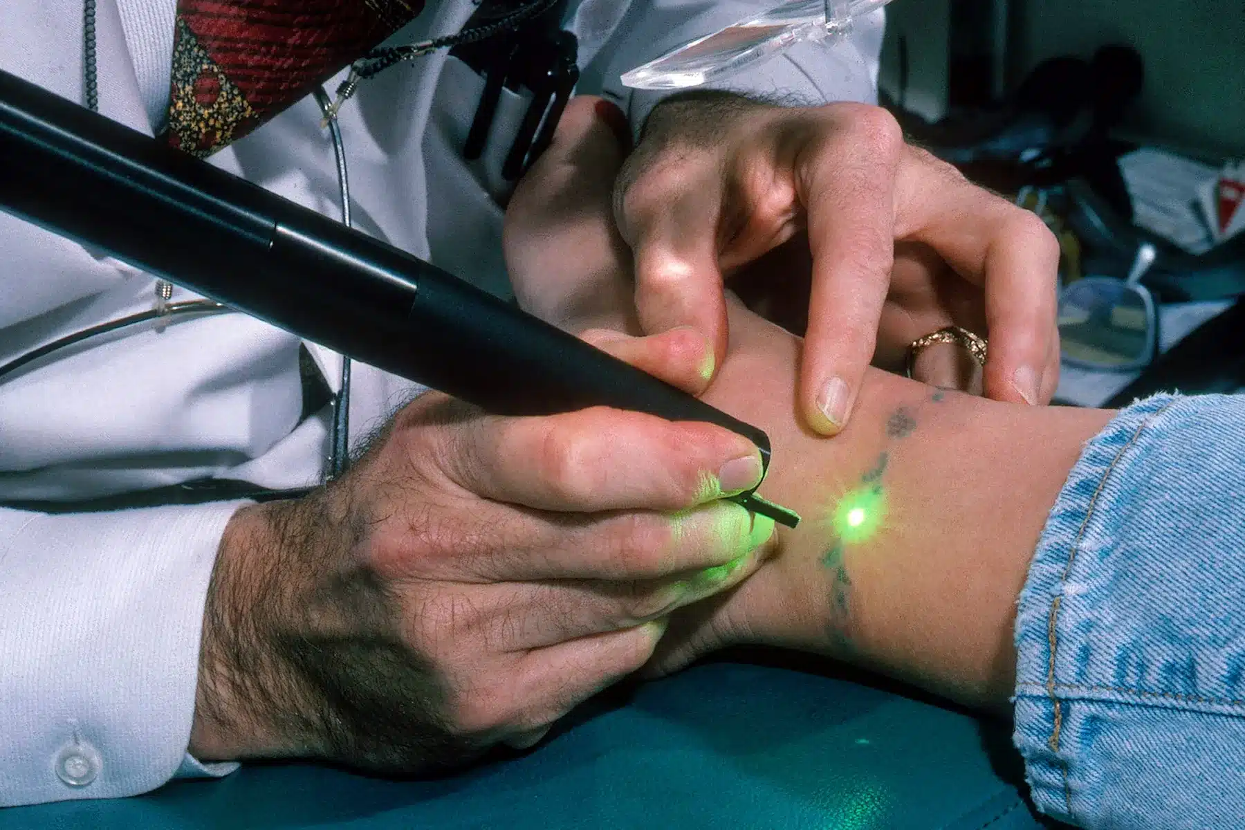 How Much Does Tattoo Removal Hurt?