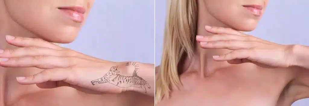 How Tattoos Are Removed