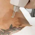 Quanta Tattoo Removal