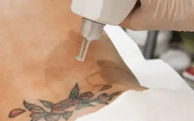 Quanta Tattoo Removal in Winter Park – Safe & Permanent Results