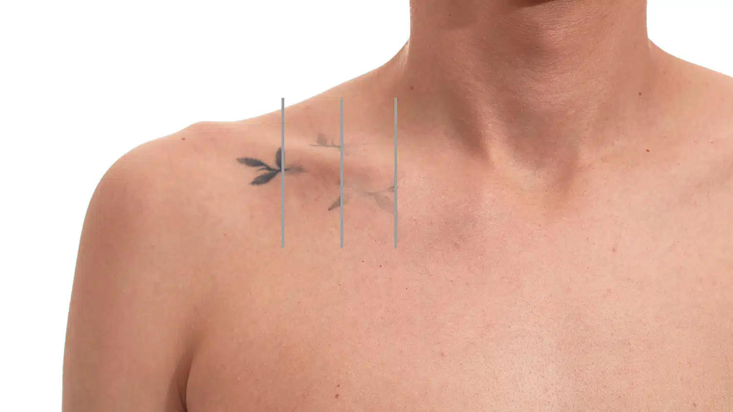 Tattoo Removal Near Me