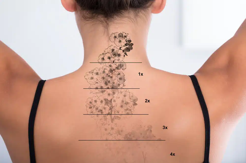 Tattoo Removal Near Me